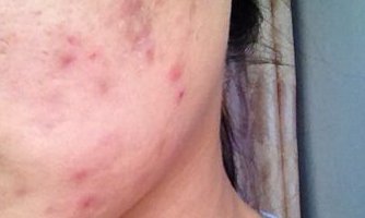 造成痘痘的13个原因都是什么？