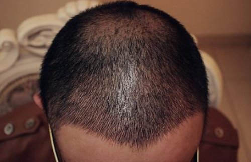 新华社暗访植发市场发现了什么情况？