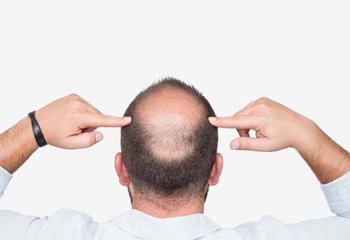 植发费用换算后超北京三环内房价,植发为何会这么贵呢?