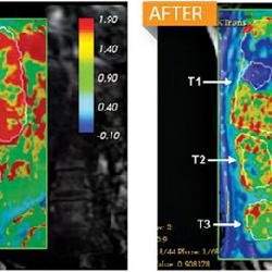 ALN-VSP的治疗效果
