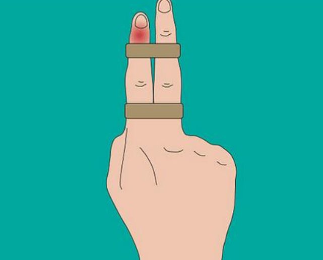 打篮球触指怎么办?