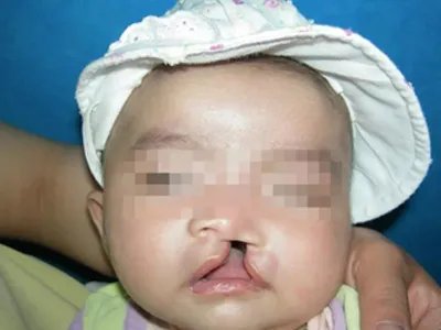 先天性风疹综合征症状图片