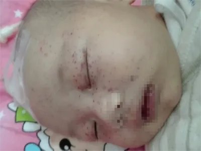 先天性风疹综合征症状图片