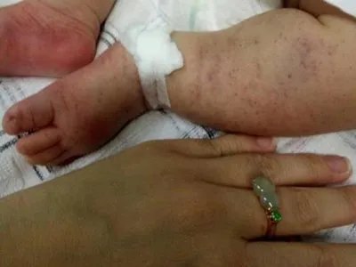 先天性风疹综合征症状图片