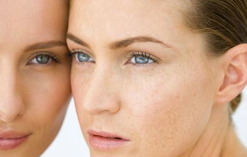 光子嫩肤祛斑多少钱