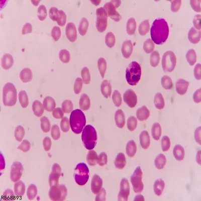 沙门菌食物中毒的常见症状和预防措施