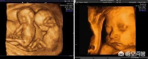 怀了双胞胎，他们会在妈妈肚子里打架吗？