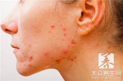 治玫瑰痤疮最好方法有哪些呢？