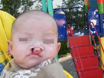 先天性风疹综合征症状图片