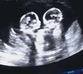 怀了双胞胎，他们会在妈妈肚子里打架吗？