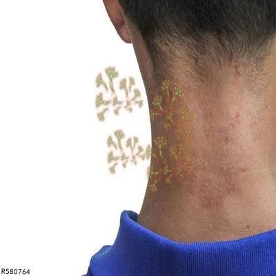 花斑癣怎么治疗最好 治疗花斑癣的方法