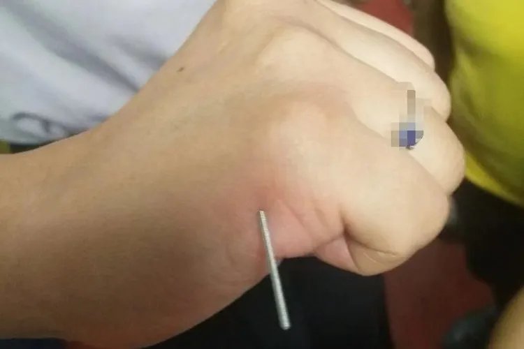 后溪针灸手法图片