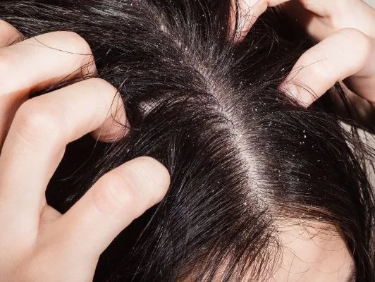 少白头怎么治疗