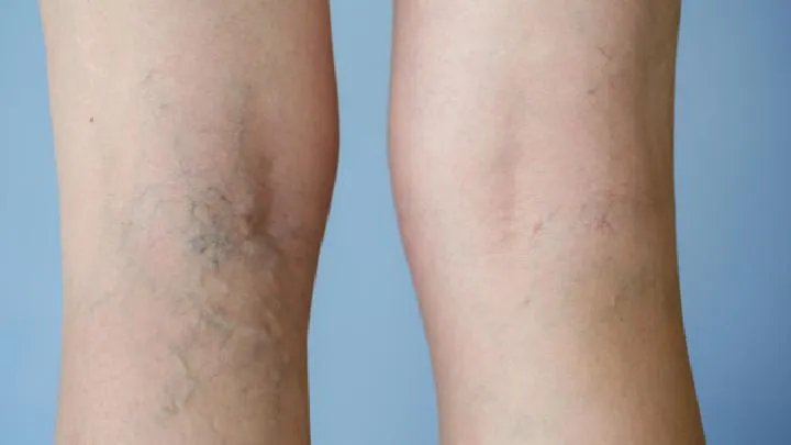 骨关节炎的发病原因是什么