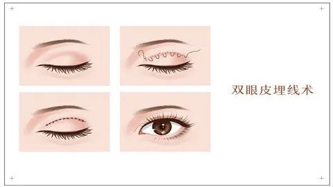 割双眼皮的坏处