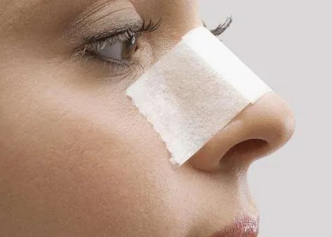 鼻翼缩小手术费用是多少