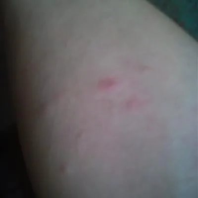 湿疹怎么治疗能根治