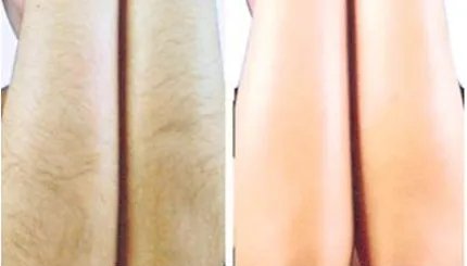 北京全身的脱毛需要多少费用