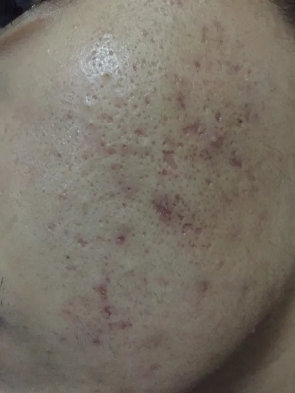 激光去痘印价格