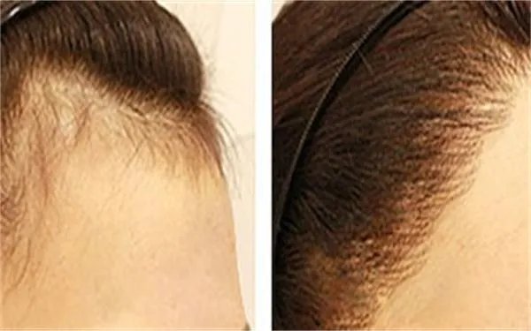 种植发际线要多少钱