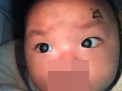 先天性风疹综合征症状图片