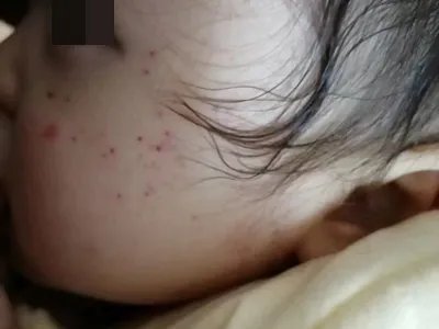 先天性风疹综合征症状图片