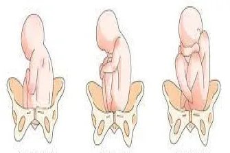 胎位lsa是什么位置图片