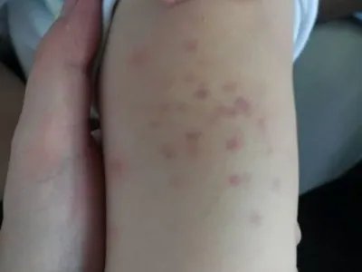 先天性风疹综合征症状图片