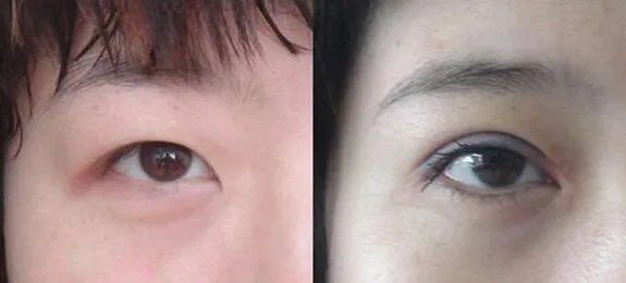 重庆开内眼角好的医院是哪家