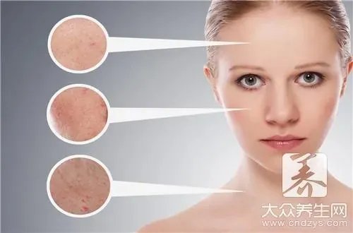 治玫瑰痤疮最好方法有哪些呢？