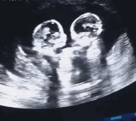 怀了双胞胎，他们会在妈妈肚子里打架吗？
