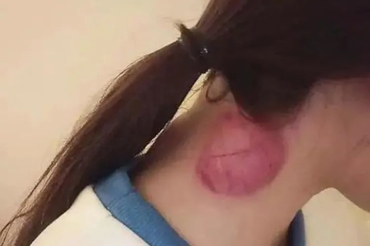 拔罐后皮肤颜色鉴别图片大全