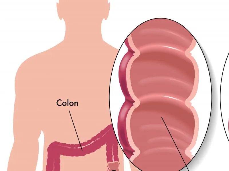 肠息肉的治疗方式
