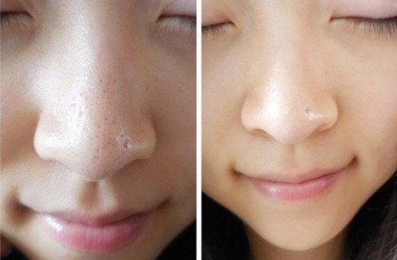 光子嫩肤去黑头效果好吗