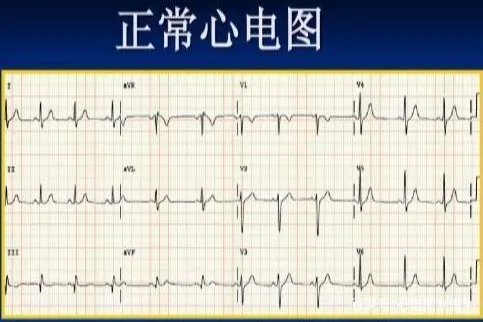 心电图普通正常图片
