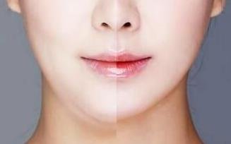 重庆祛斑费用大概是多少啊