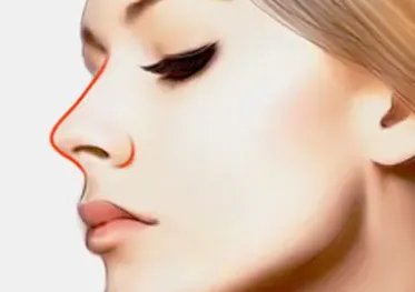 射频除皱术价格