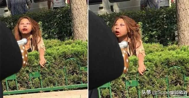 山东小三当街被打成猪头，据说当时已经神志不清了，现在好了吗？