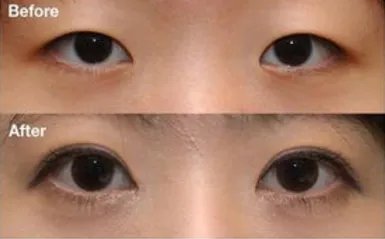 韩式埋线双眼皮好多钱