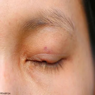 眼皮摸着有个小豆豆怎么回事