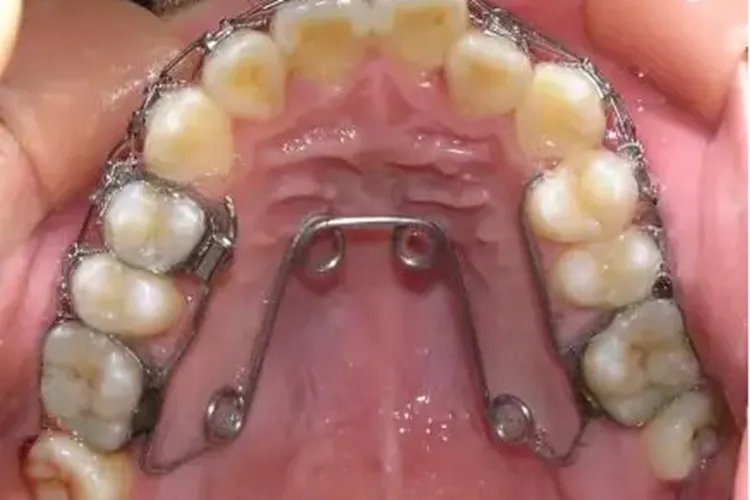 扩弓器矫正牙齿图片