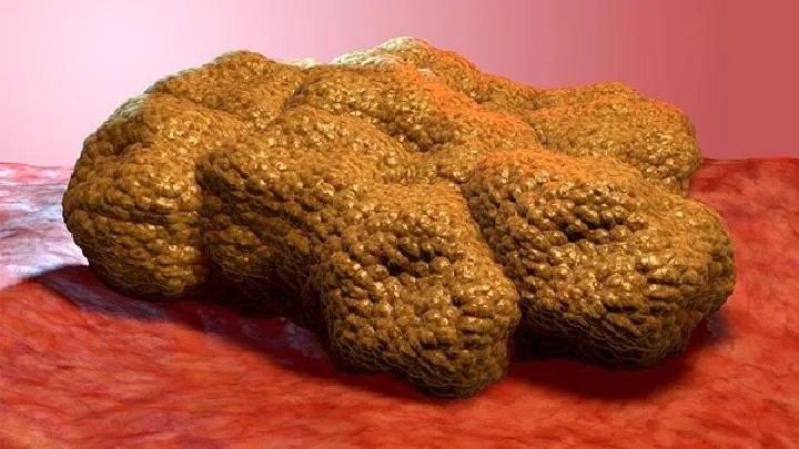 土拉菌病有哪些典型症状