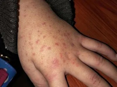 先天性风疹综合征症状图片