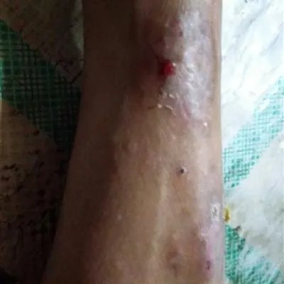 湿疹怎么治疗能根治