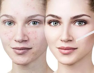 怎么样祛痘快速