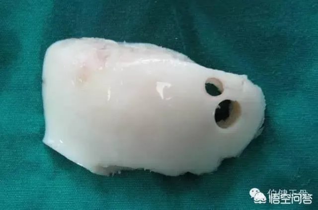 同种异体骨是不是移植的死人骨头？我很难接受？