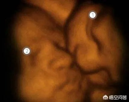 怀了双胞胎，他们会在妈妈肚子里打架吗？