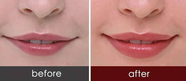 玻尿酸丰唇的价格是多少