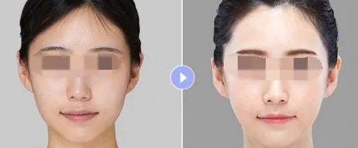 彩光嫩肤多少钱一次