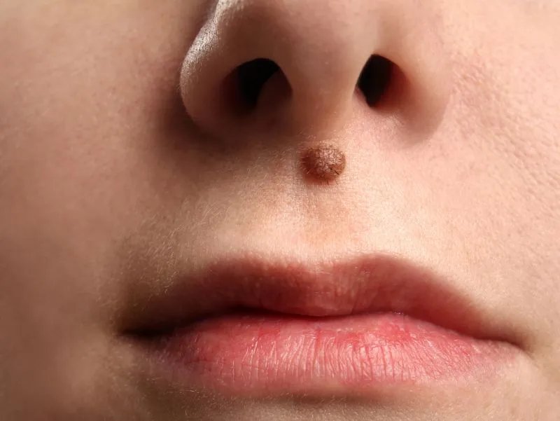 鼻子上长红包的原因